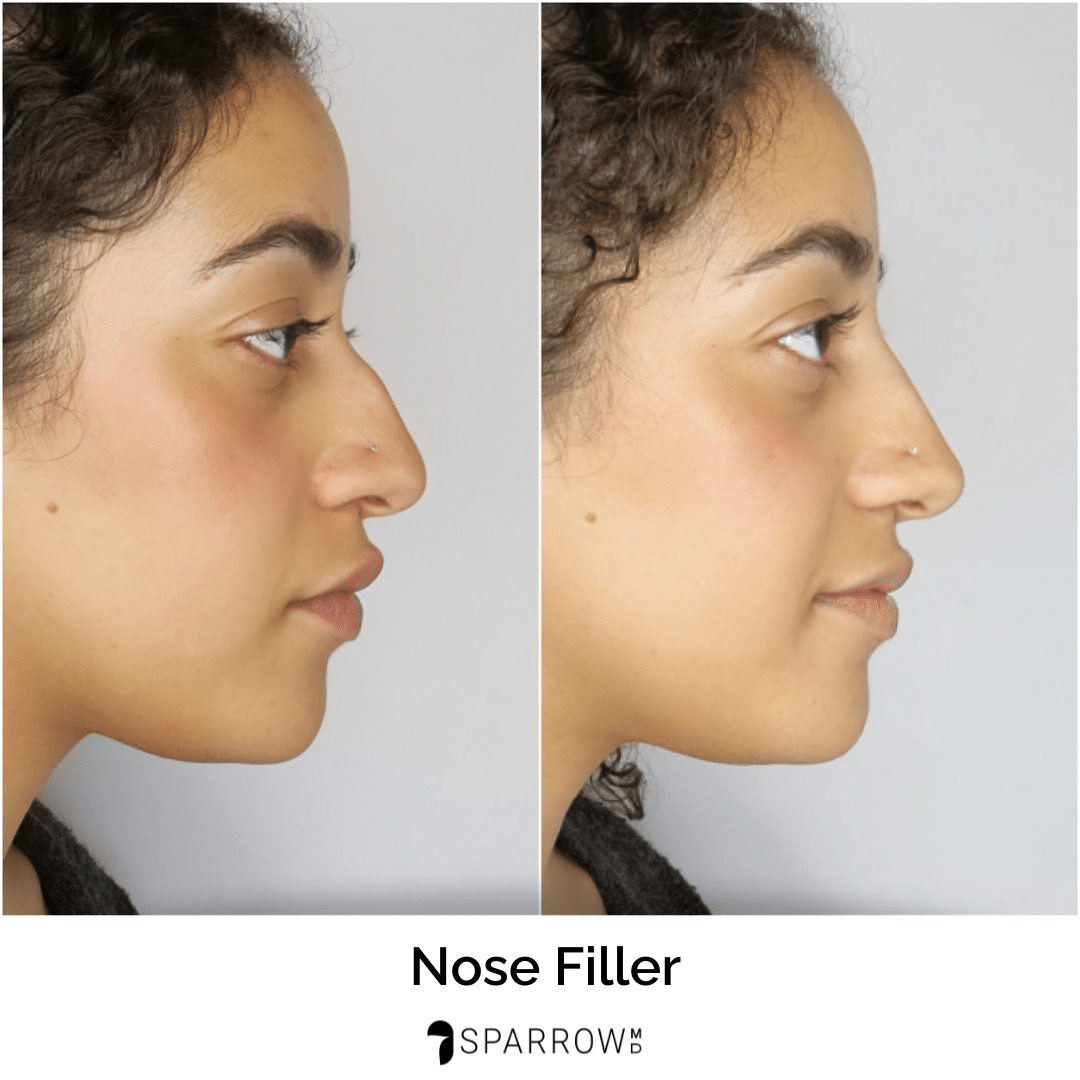 fillers vancouver nose job before and after Vancouver