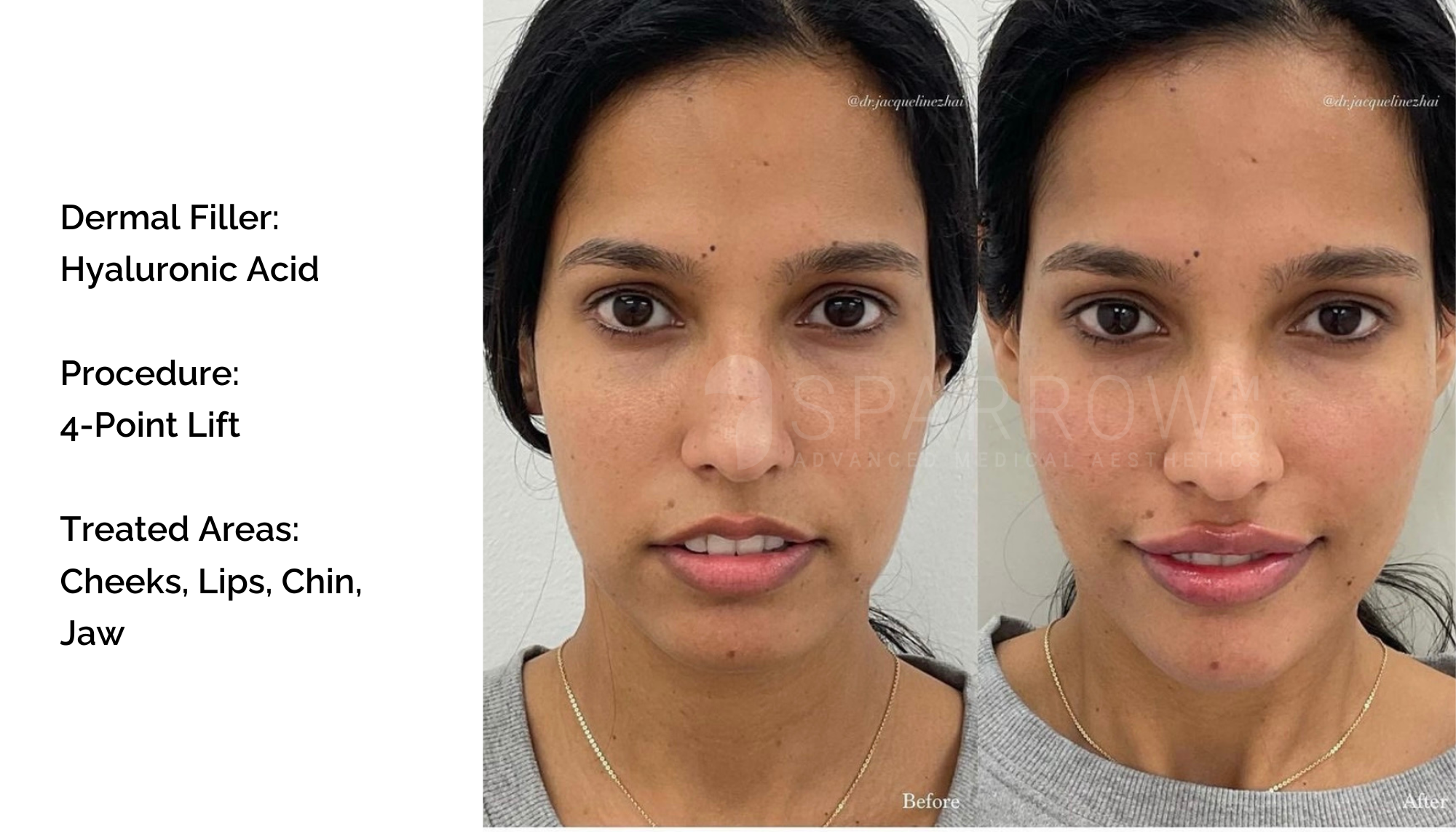 fillers Vancouver profile balancing
