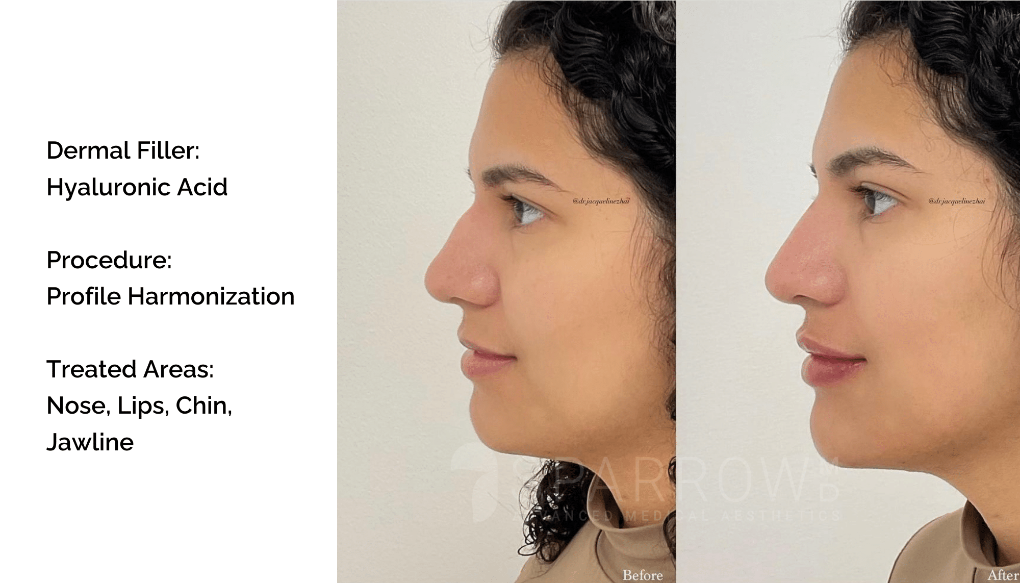vancouver dermal fillers before and after