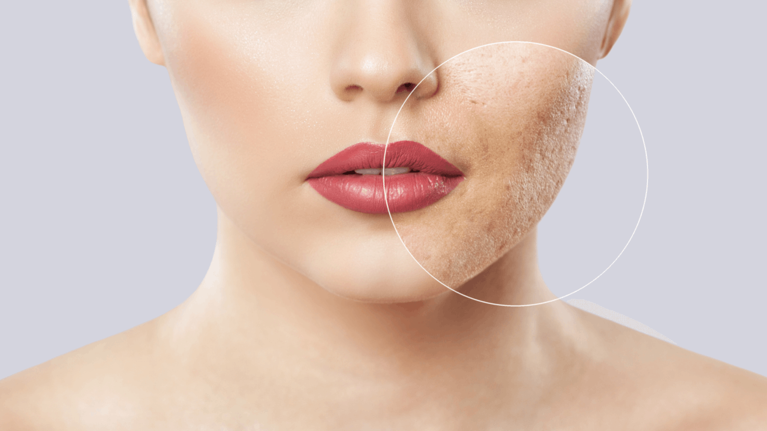 Improve your self confidence with acne scar treatments at Sparrow MD clinic in Vancouver.