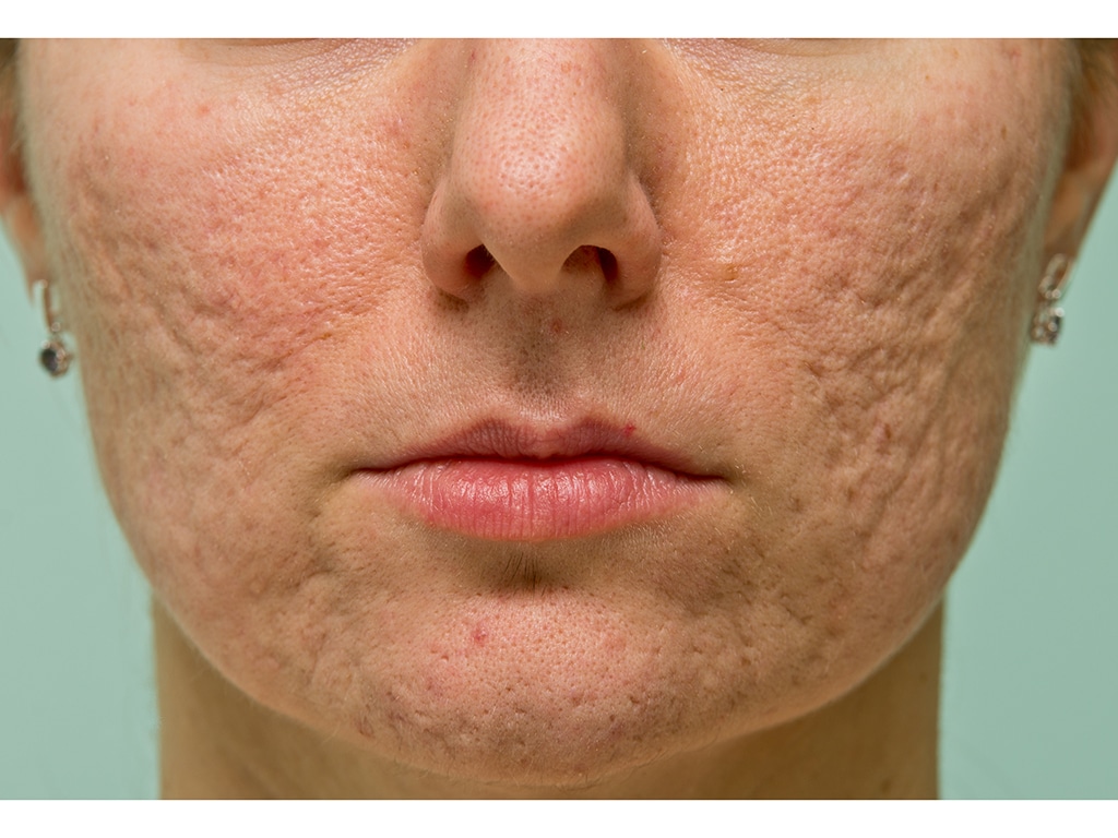 Sparrow MD provides comprehensive treatments for all types of acne scar Vancouver