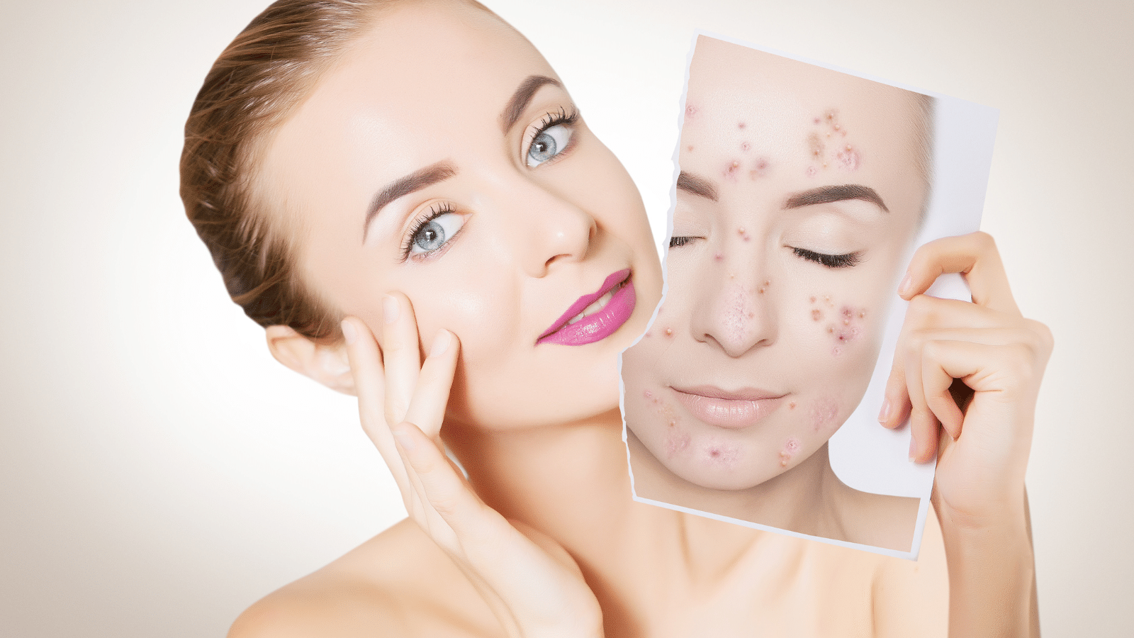 Customised subcision treatment for acne scars get high satisfaction rates at Sparrow MD in Vancouver.