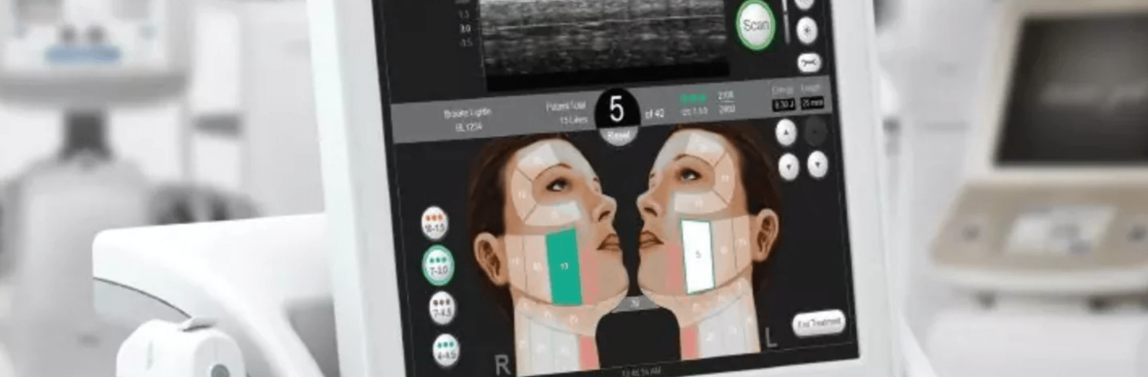 Is ultherapy right for me top 7 facts to know about ultherapy treatment best non surgical skin tightening and face lifting treatment Vancouver sparrow Md