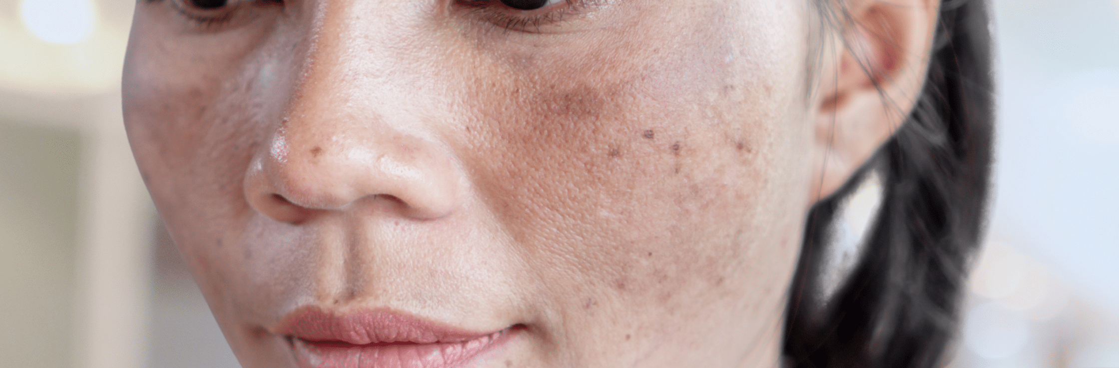 Understanding Lumenis M22 Photofacial treatment ultimat guide to ipl for clearer skin redness rosacea acne skin rejuvenation anti aging pigmentation sun damage melasma dry skin large pores best