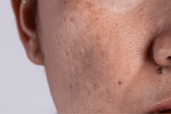 exosomes for acne scarring top 5 facts medical grade skin management best skincare clinic Vancouver sparrow md physician led safety results acne scarring pigmentation correction