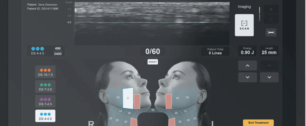 ultherapy treatment top frequently asked questions best non surgical facelift treatment Vancouver sparrow md physician led ultrasound guided skin tightening anti aging