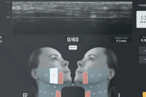 ultherapy treatment top frequently asked questions best non surgical facelift treatment Vancouver sparrow md physician led ultrasound guided skin tightening anti aging