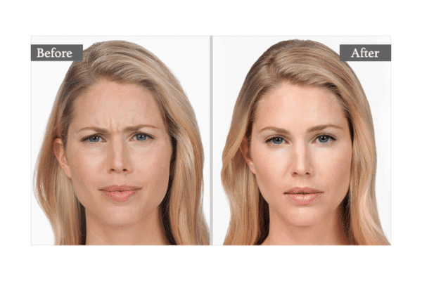 patient showing her before and after of her treatment of botox and the effects